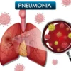 Pneumonia Selalu Mengintai Anak-Anak Kita, Ini Cara Mudah Pencegahannya menurut IDAI