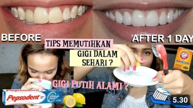 Cara Memutihkan Gigi dalam waktu 1 Hari