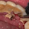 Penyebab karang gigi
