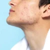 ilustrasi jenis kulit acne prone