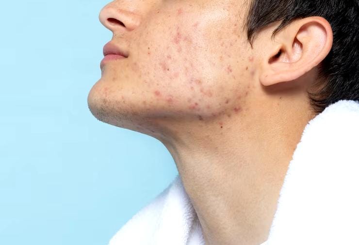 ilustrasi jenis kulit acne prone